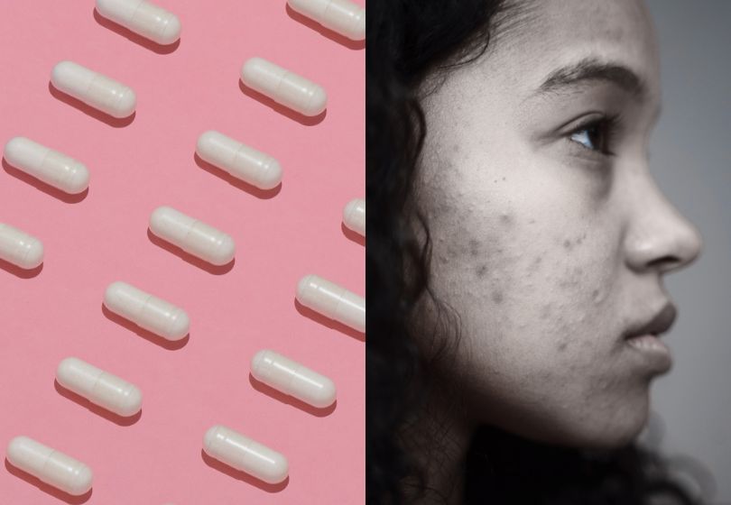Does Biotin Cause Acne or Other Side Effects?